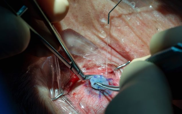 Implantacja keratoprotezy