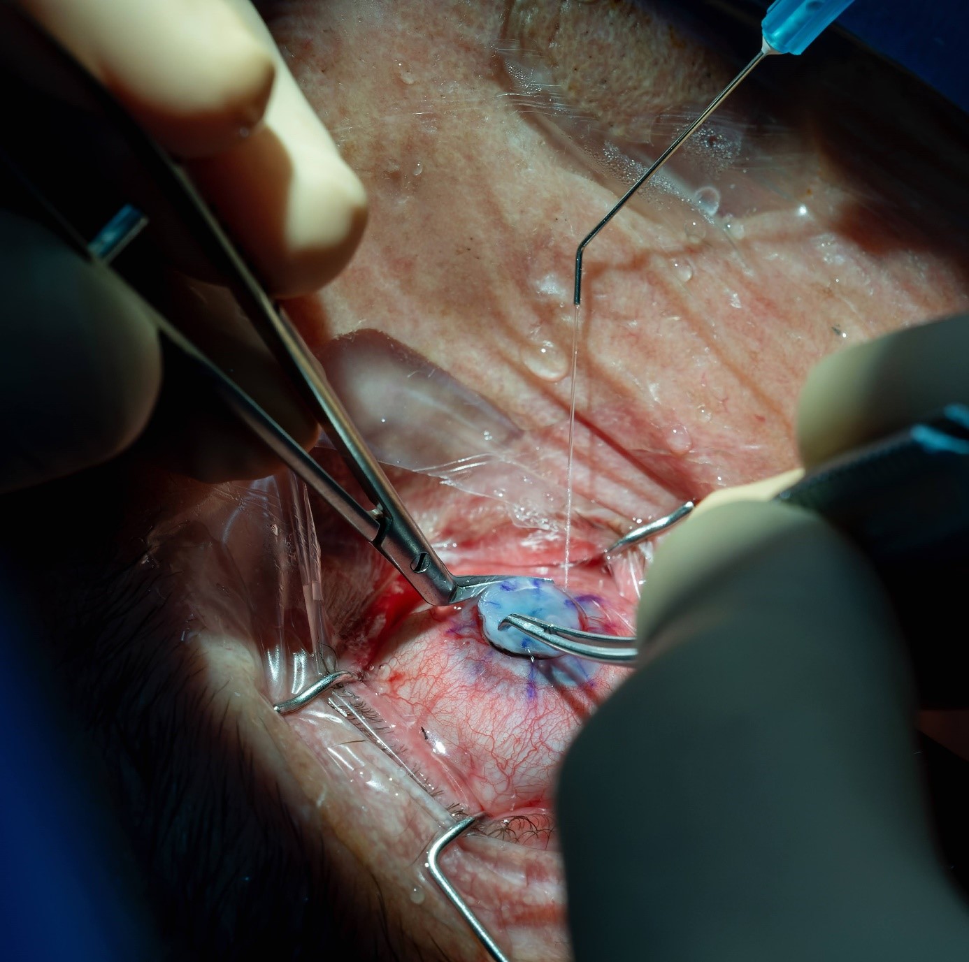 Implantacja keratoprotezy