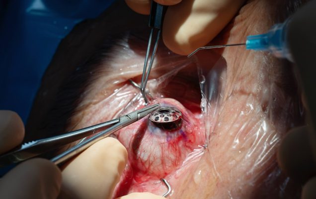 Implantacja keratoprotezy