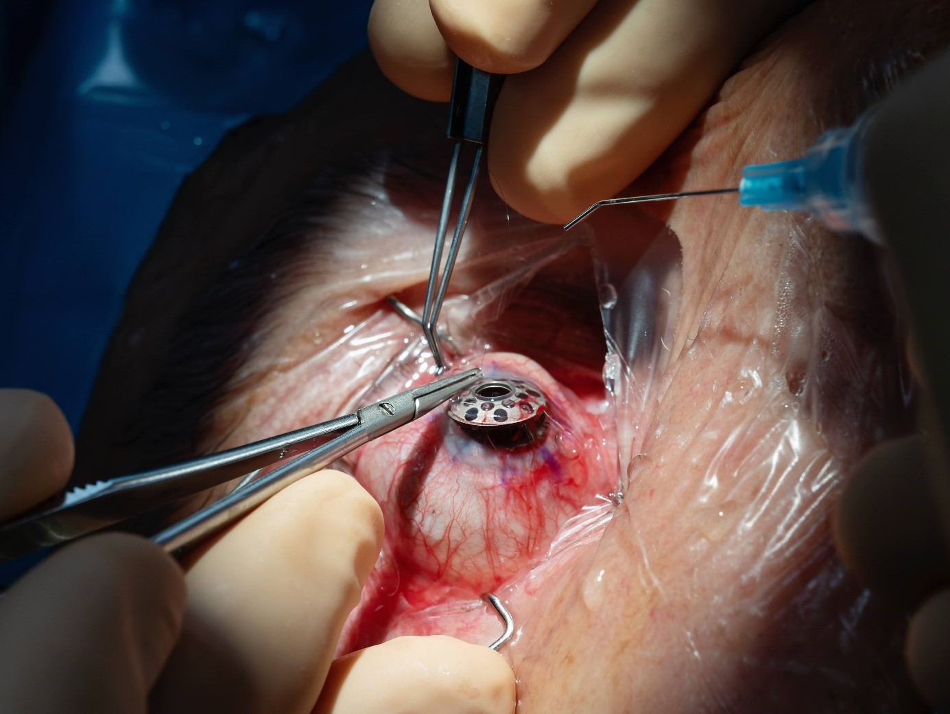 Implantacja keratoprotezy